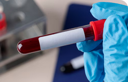 Liquid biopsy